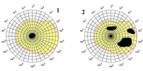 Виды периметрии Виды периметрии