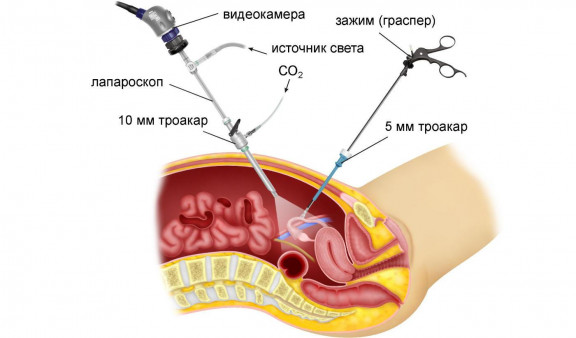Как делают лапароскопию маточных труб