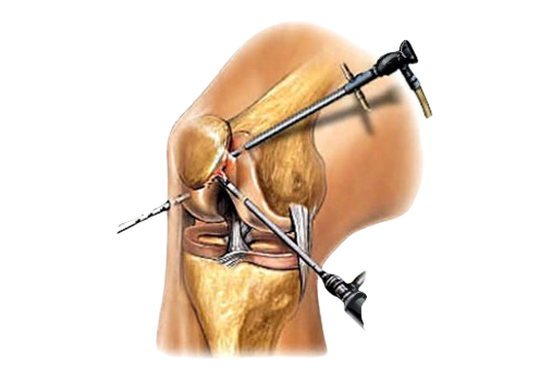 Артроскопия коленного сустава до