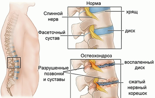 Остеохондроз