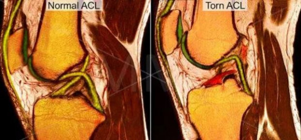 Что показывает МРТ мягких тканей бедра  Что показывает МРТ мягких тканей бедра