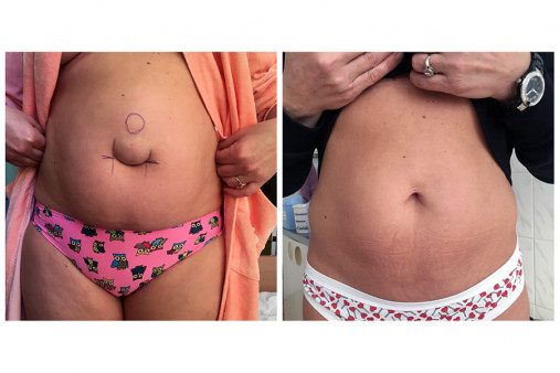 Операционная грыжа Операционная грыжа