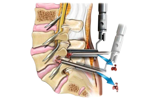 Удаление грыжи позвоночника до