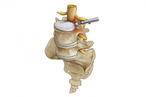Эндоскопическое удаление грыжи позвоночника