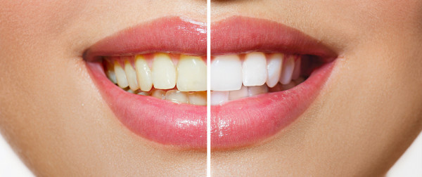 Чистка зубов Air Flow  Чистка зубов Air Flow