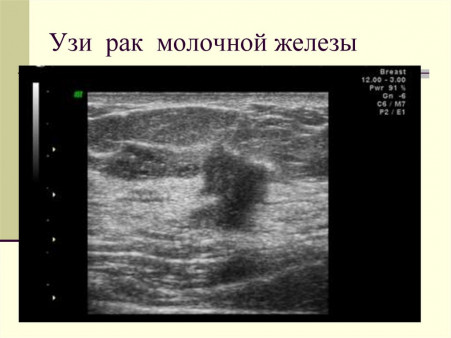 УЗИ молочных желез - 3 