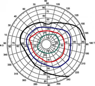 Компьютерная периметрия глаза - 3 