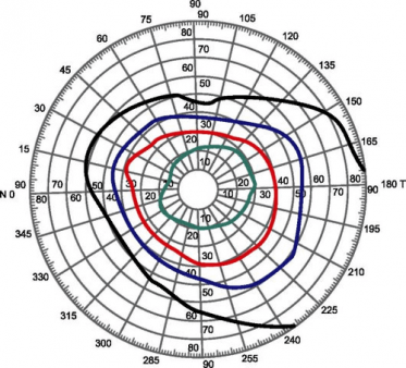 Результаты компьютерной периметрии Результаты компьютерной периметрии