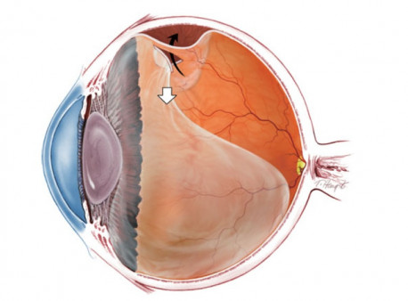 Причины отслоения сетчатки Причины отслоения сетчатки