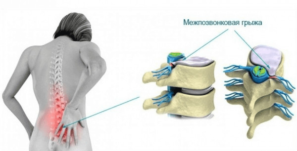 Межпозвонковая грыжа