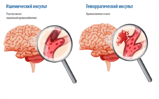 Инсульт - 2 