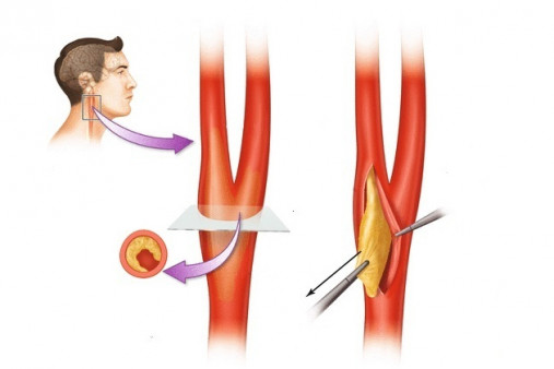 После каротидной эндартерэктомии. Каротидная эндартерэктомия сонной артерии. Эндартерэктомия ход операции. Эндартерэктомия каротидная нейрохирургия.