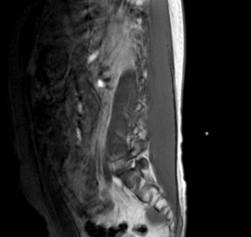 МРТ пояснично-крестцового отдела позвоночника, сагиттальный парамедианный срез 