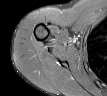 Аксиальный снимок МРТ плечевого сустава МРТ плечевого сустава, аксиальный срез