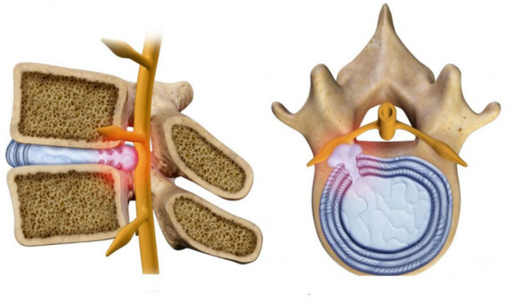 Причины протрузии поясничного отдела Причины протрузии поясничного отдела