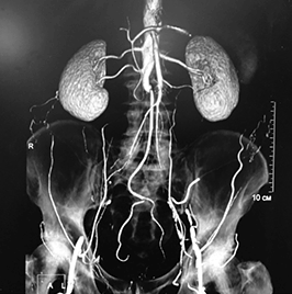 КТ мочевыделительной системы - 2 