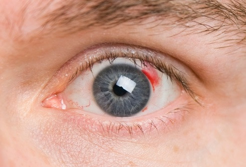 Гипертоническая ретинопатия Гипертоническая ретинопатия