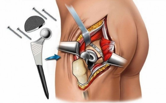 Операция эндопротезирования тазобедренного сустава