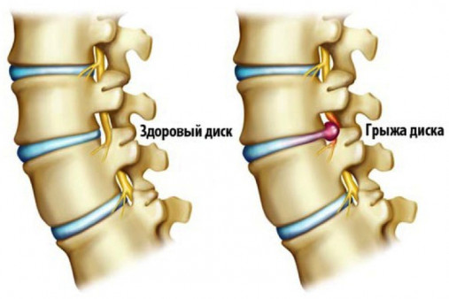Мануальная терапия при грыже позвоночника 