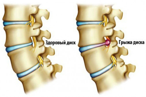 Грыжа позвоночника Грыжа позвоночника