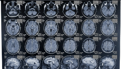 МРТ снимки головного мозга