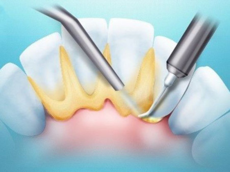 Зубной камень - 2 