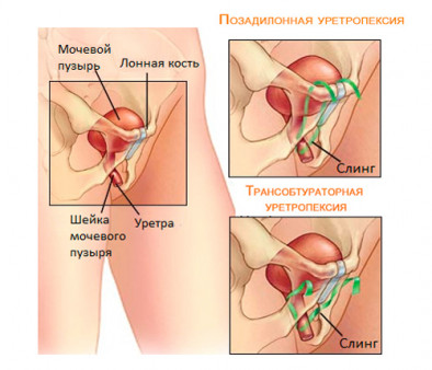 Недержание мочи - 4 