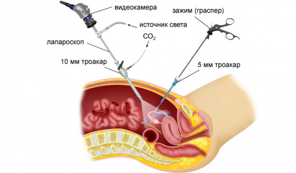 Как делают лапароскопию яичников