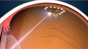 Как лечить отслоение сетчатки Как лечить отслоение сетчатки