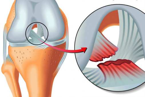 Разрыв крестообразной связки коленного сустава