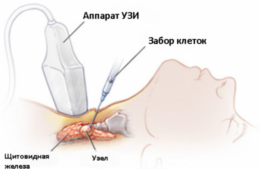 Биопсия щитовидной железы - 2 