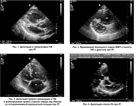 УЗИ сердца - 3 