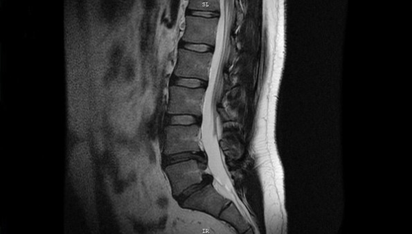 Лечение грыжи поясничного отдела в «Открытой клинике» Лечение грыжи поясничного отдела в «Открытой клинике»