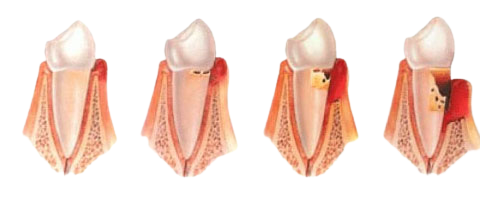 Периодонтит - 2 