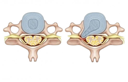 Удаление грыжи позвоночника 