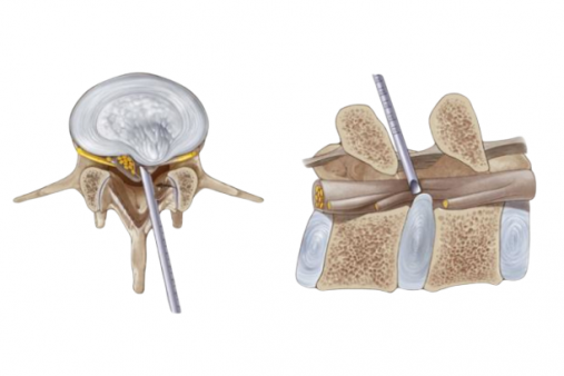 Эндоскопическое удаление грыжи позвоночника до