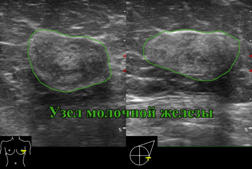 УЗИ молочных желез - 2 