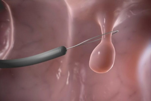 Методы удаления полипов в носу Методы удаления полипов в носу