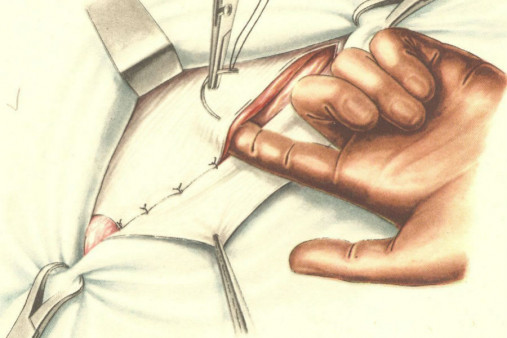 Паховая грыжа лечение Паховая грыжа лечение