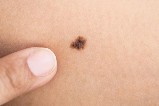 Удаление родинок до