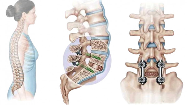 Транспедикулярная фиксация - 5 