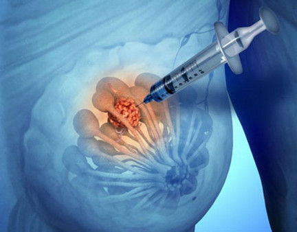 Биопсия молочной железы Биопсия молочной железы