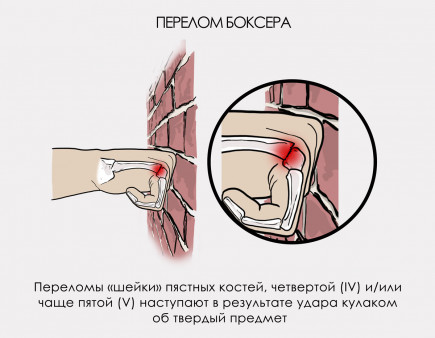 Перелом пястных костей причины