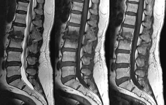 Диагностика протрузии поясничного отдела Диагностика протрузии поясничного отдела