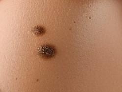 Бородавки на груди