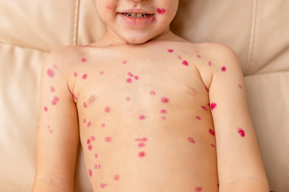 Сыпь на груди у ребенка