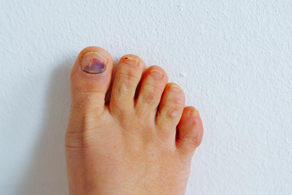 Потемнение ногтя на ноге