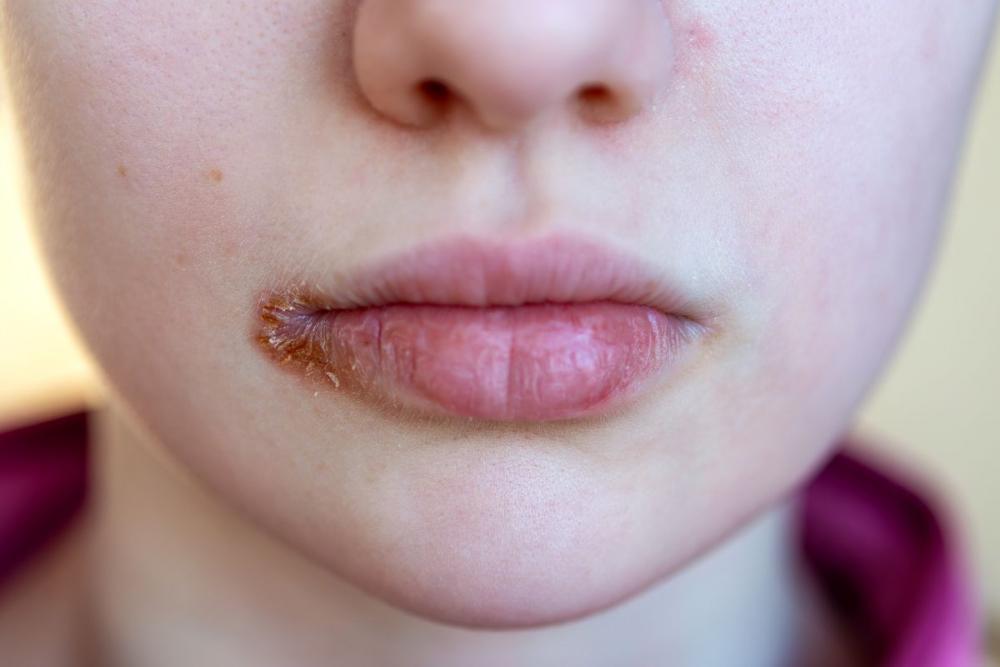 Простуда на губах: причины и лечение