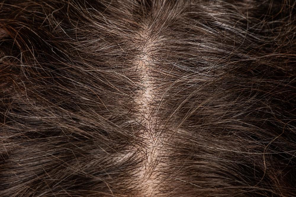 Прыщи на голове