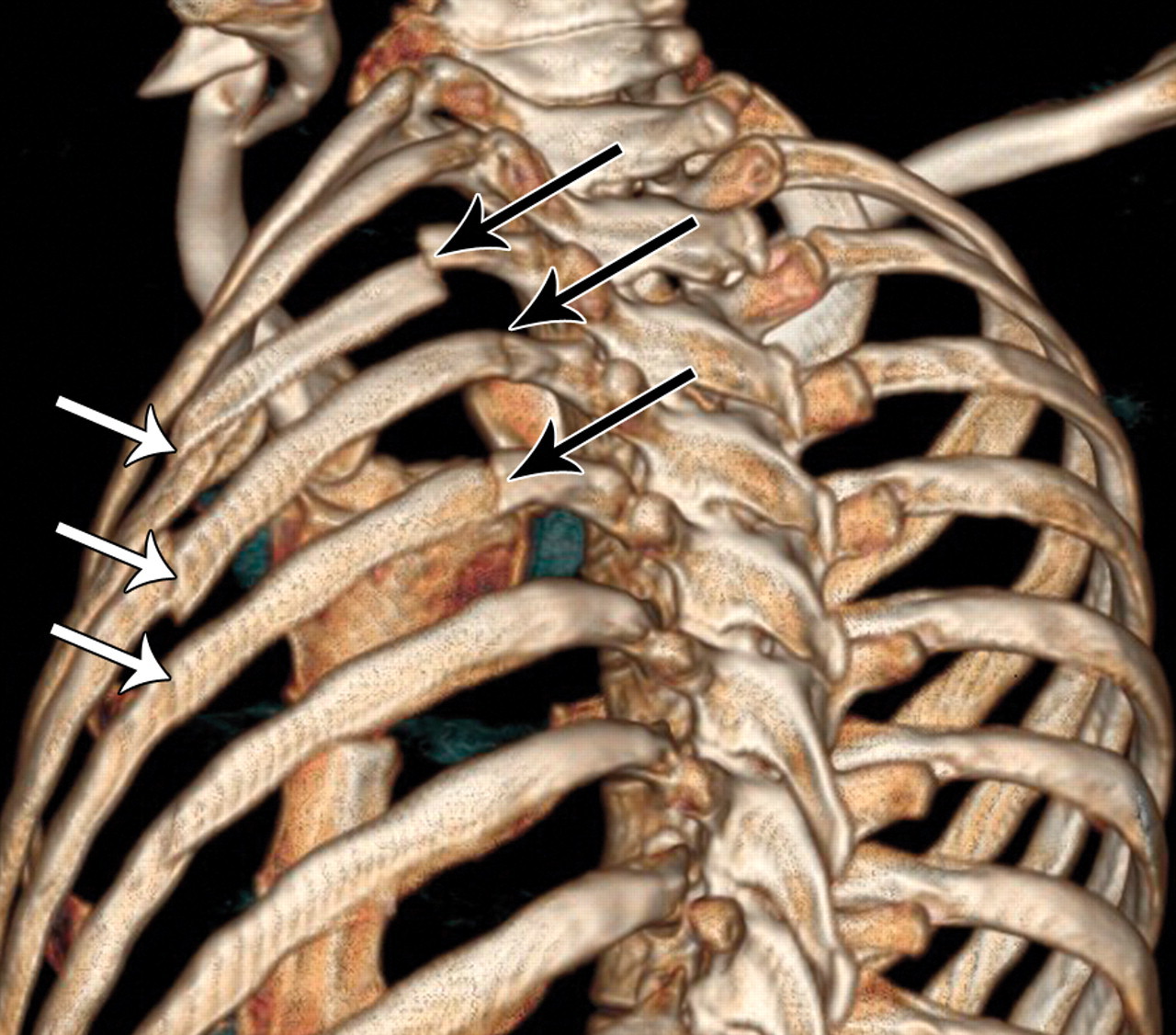 Лечение перелома ребер